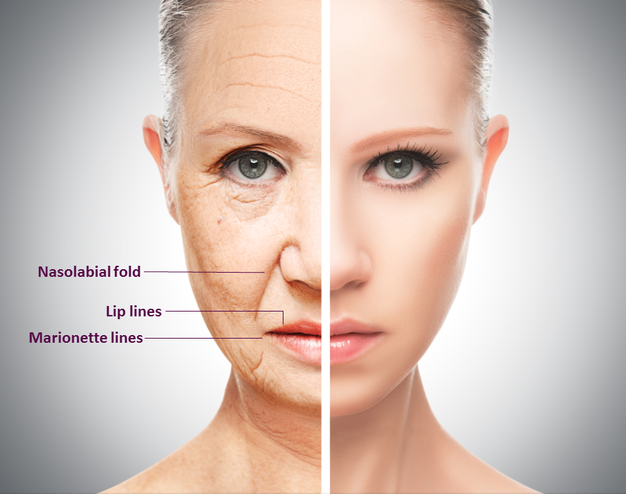 raised acne scar treatment