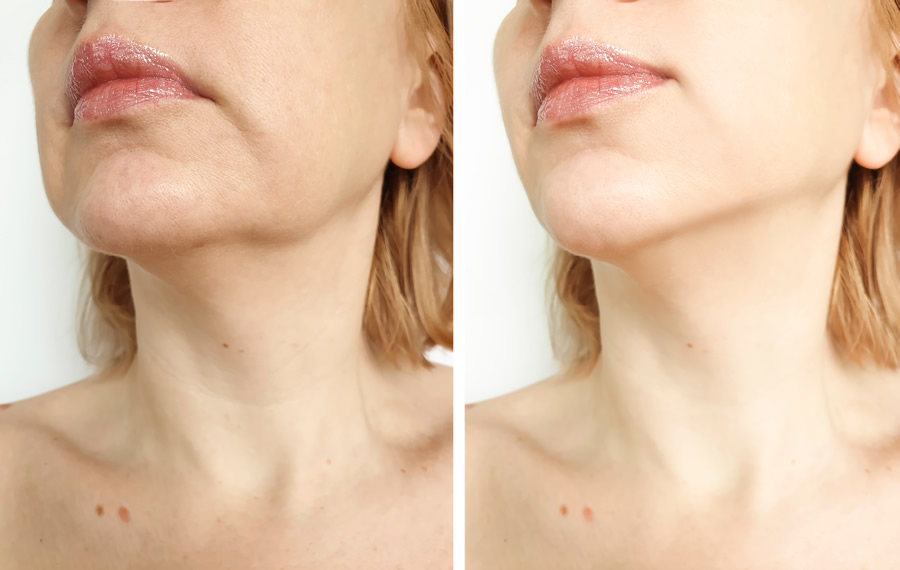 raised acne scar treatment