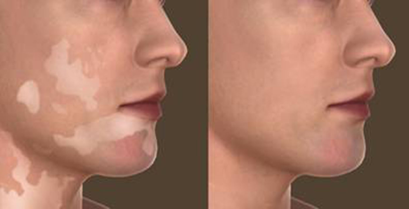 raised acne scar treatment